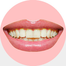 牙渍牙斑